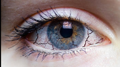 Sécheresse oculaire
